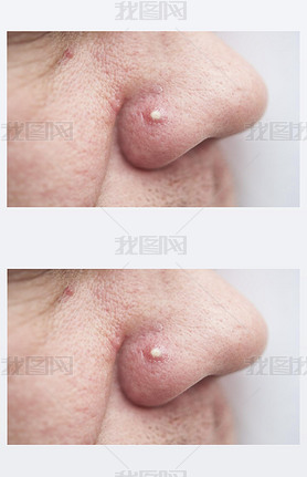 close-up of pimple