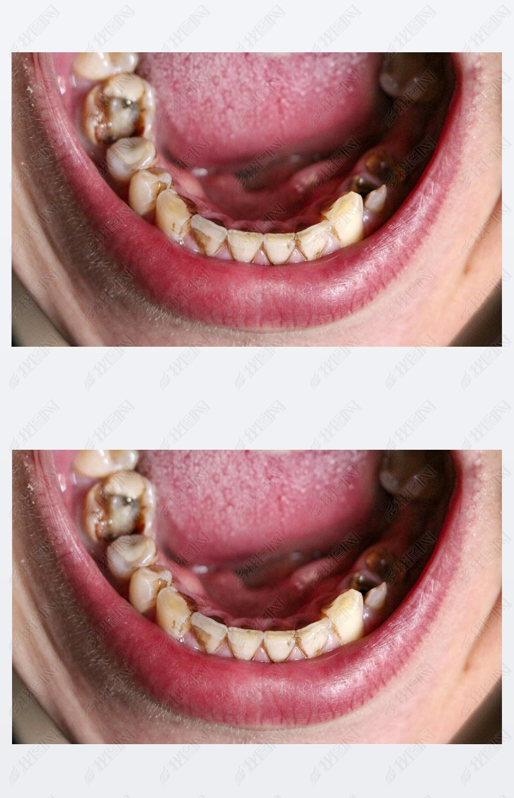 牙龈和牙周炎导致张嘴牙齿破碎疾病牙龈中的钢销用于安装牙冠吸烟者的