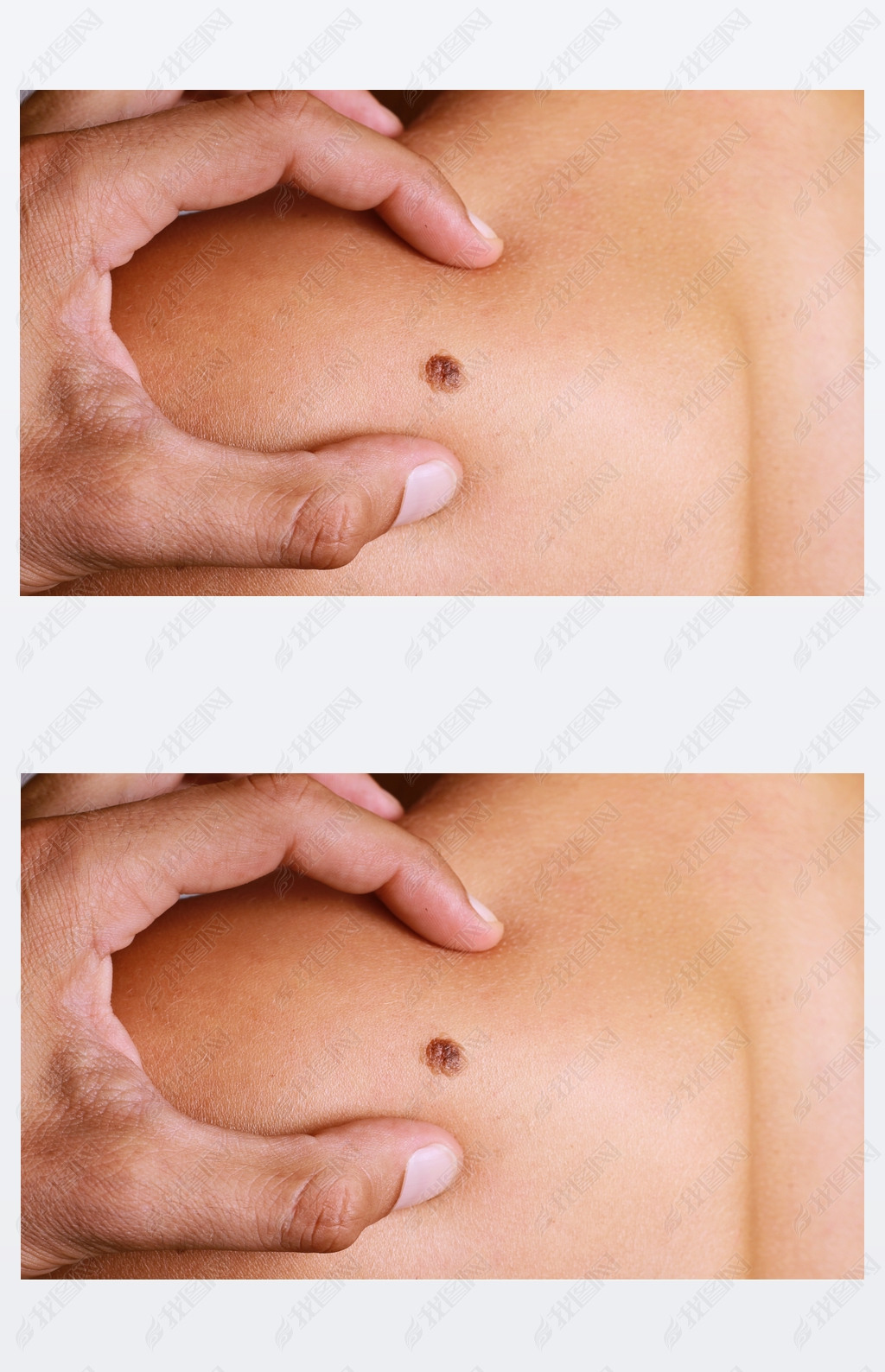 Doctor , Dermatologist, hands examines a birthmark of patient. Checking benign moles