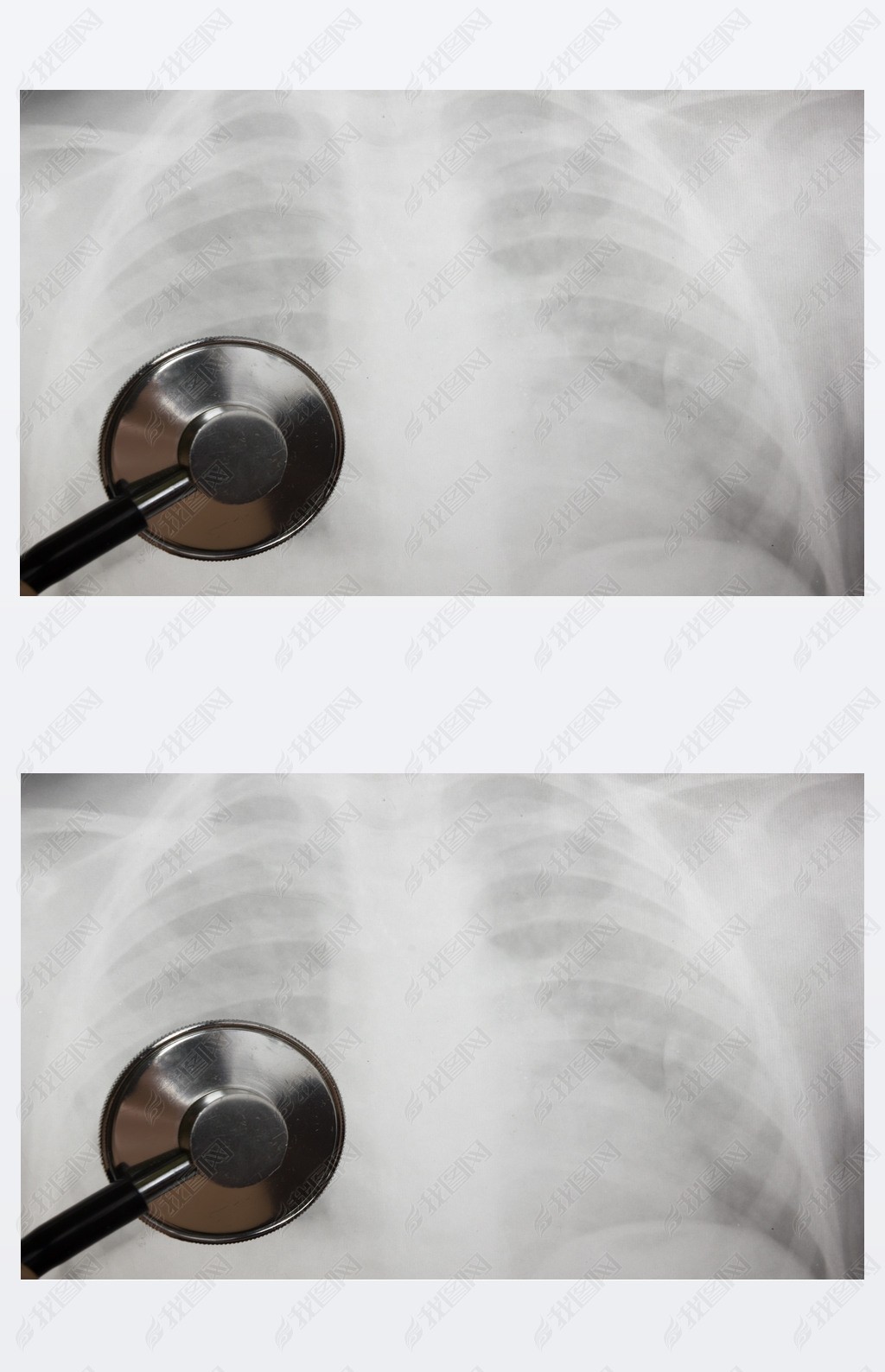 Medical stethoscope and x-ray or roentgen image. Close-up shot of lung radiography