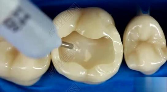 牙齿电钻钻洞补牙音效