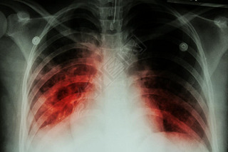 ν (Tb): ز x ʾݽڽ˷֦˾ν infectionpulmonary  (Tb) : ز x ʾ infiltratio