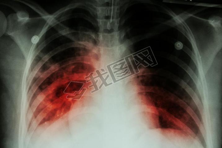 ν (Tb): ز x ʾݽڽ˷֦˾ν infectionpulmonary  (Tb) : ز x ʾ infiltratio