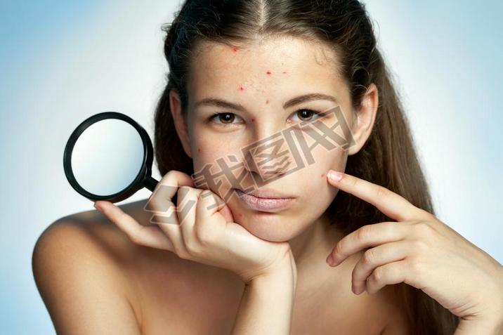 Girl with a pimply face holding magnifying glass. Woman skin care concept