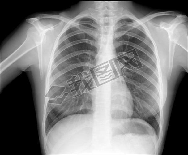 Chest x-ray, pneumonia prophylaxis