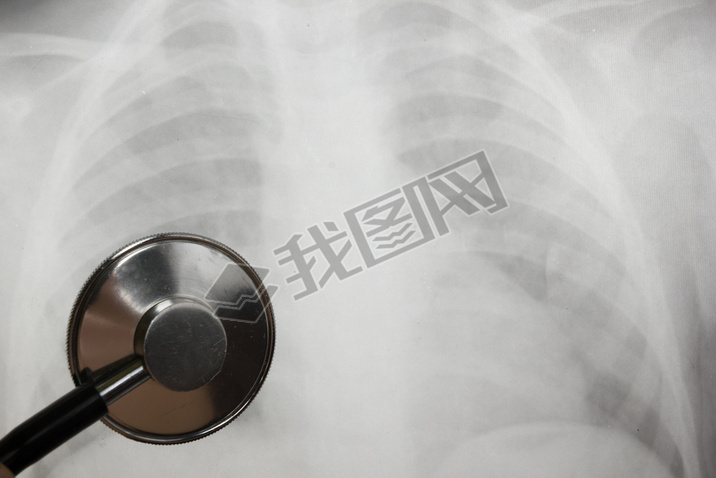 Medical stethoscope and x-ray or roentgen image. Close-up shot of lung radiography