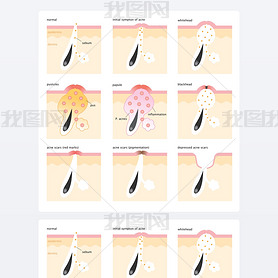 acne formation process