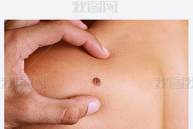 Doctor , Dermatologist, hands examines a birthmark of patient. Checking benign moles