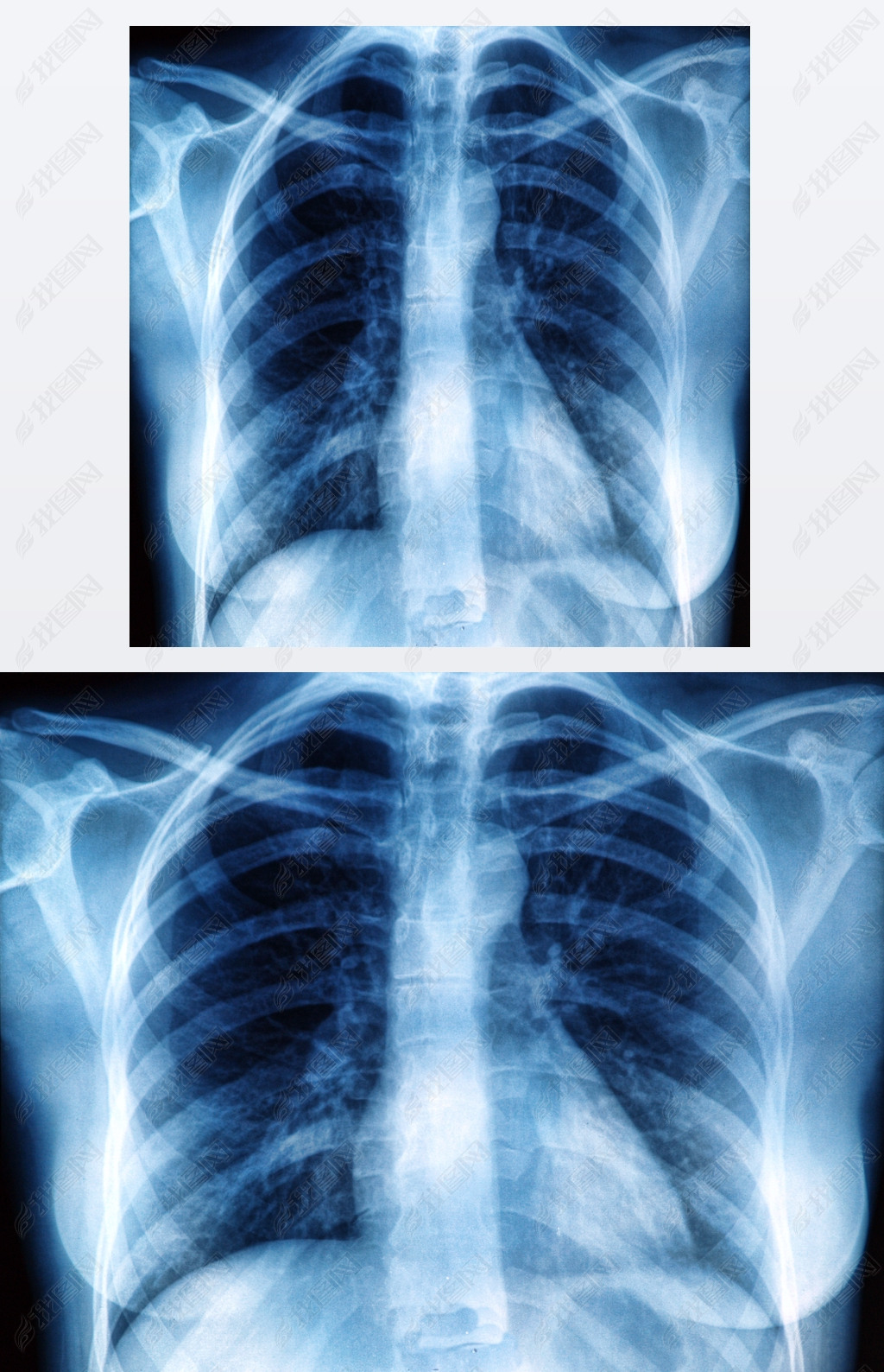胸部x 射线图像