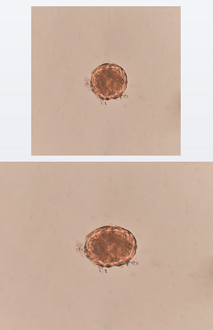 凳子考试蛔虫蛔虫卵
