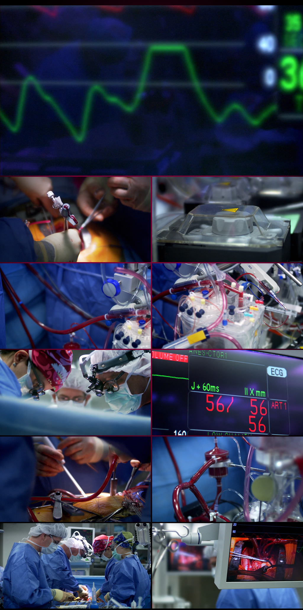 高清实拍现代医学显微外科心脏手术实景视频
