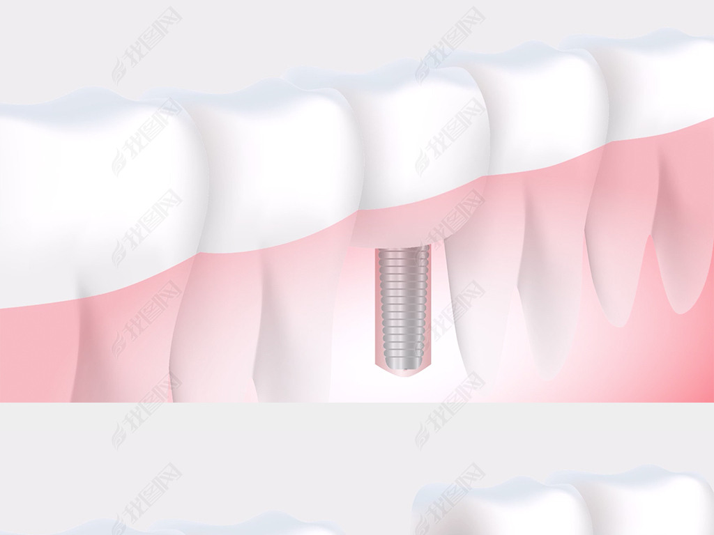 动画演示效果镶牙拔牙治牙过程牙医诊所视频