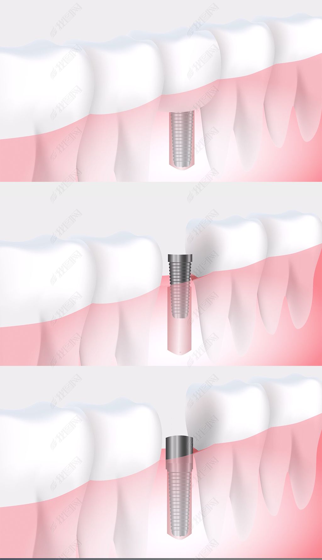 动画演示效果镶牙拔牙治牙过程牙医诊所视频