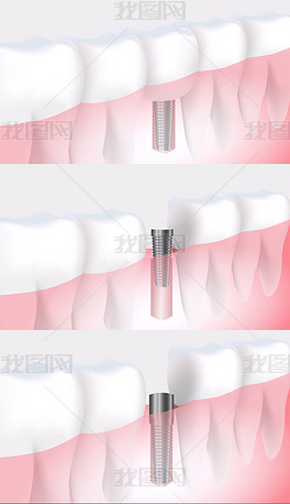 动画演示效果镶牙拔牙治牙过程牙医诊所视频类