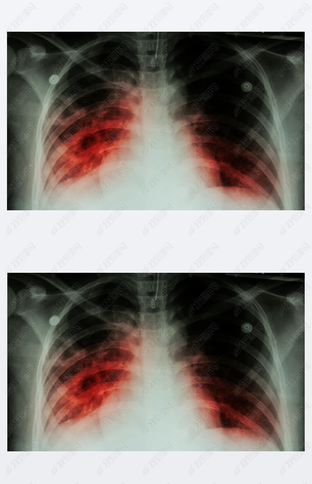 ν (Tb): ز x ʾݽڽ˷֦˾ν infectionpulmonary  (Tb) : ز x ʾ infiltratio