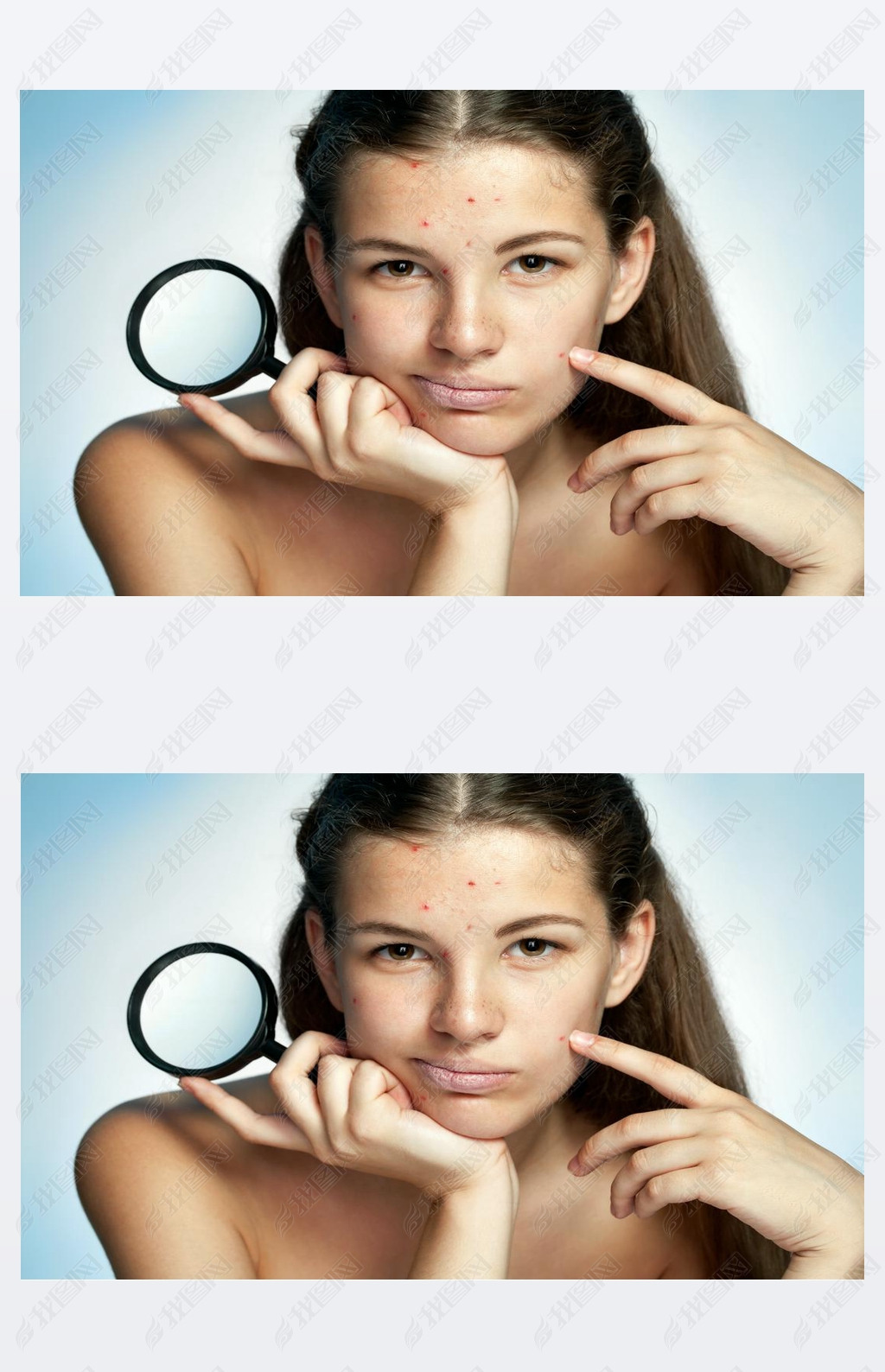 Girl with a pimply face holding magnifying glass. Woman skin care concept