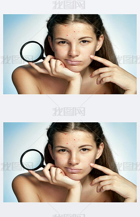 Girl with a pimply face holding magnifying glass. Woman skin care concept