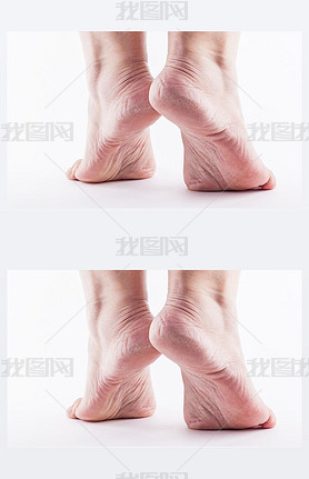 Dry heels woman on a white background closeup