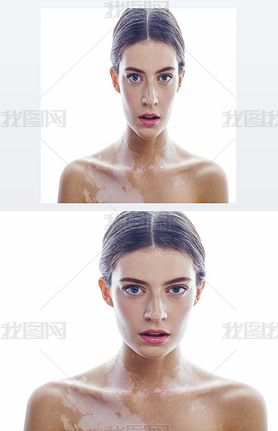 beautiful young brunette woman with vitiligo disease isolated on white positive iling, model probl