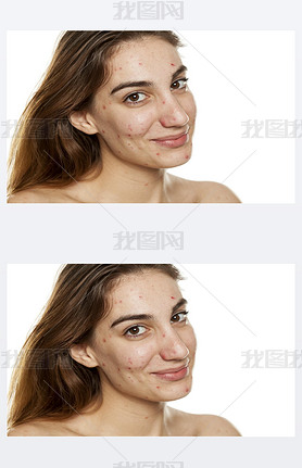 Young iling woman with problematic skin and without makeup posing on a white background