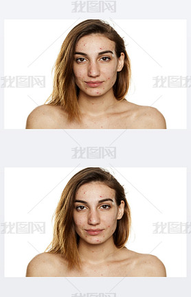 Young woman with problematic skin and without makeup posing on a white background