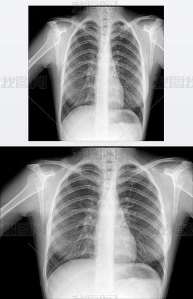 Chest x-ray, pneumonia prophylaxis