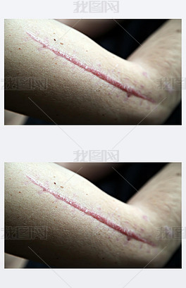 原创在人体皮肤上的疤痕