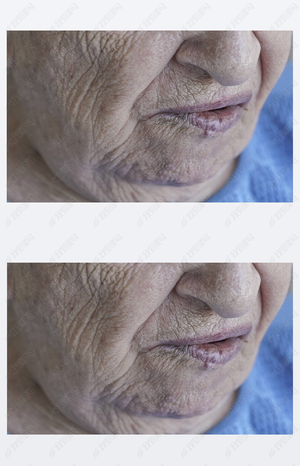 原创有面部麻痹的老人的嘴版权可商用