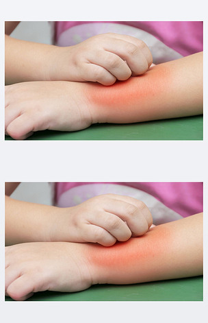 原创孩子们正在抓他们的手臂蚊子叮咬后版权可商用