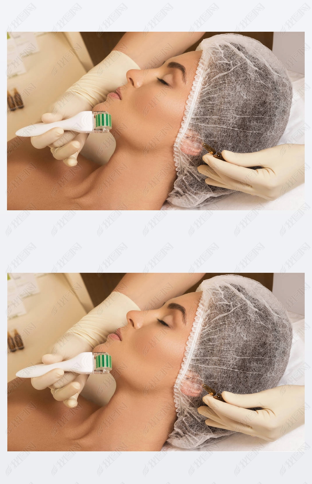 ŮԺڼ mesotherapy ϸ microneedling .