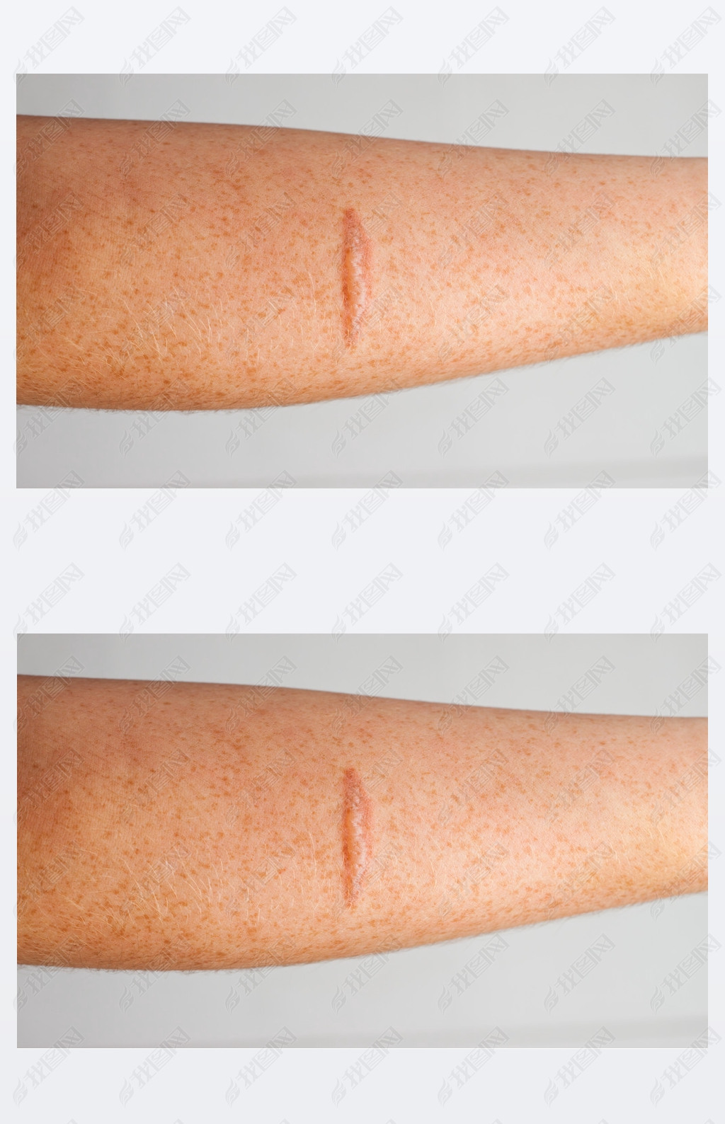 原创手臂疤痕版权可商用