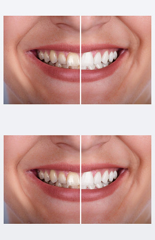 美白前后微笑女性牙齿特写