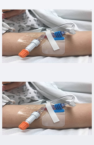 原创现代外周静脉导管在静脉输注对女性的手臂在医院版权可商用