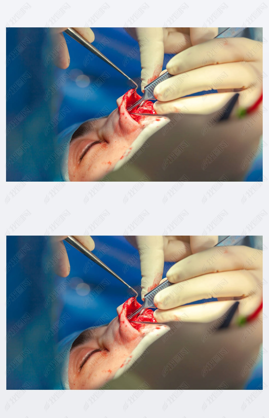 外科医生和他的助手执行整容手术在医院手术室的鼻子上鼻整形隆胸隆鼻