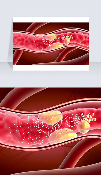 3D医疗视频截图疏通血管中的血栓