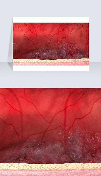 3D医疗视频医疗效果血栓被带走截图
