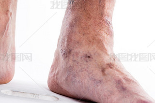 People with varicose veins of the lower extremities and venous t