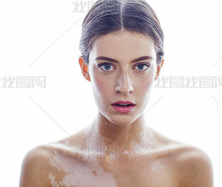 beautiful young brunette woman with vitiligo disease isolated on white positive iling, model probl
