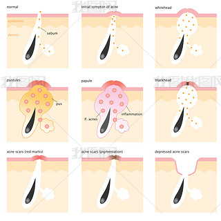 acne formation process