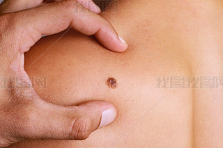 Doctor , Dermatologist, hands examines a birthmark of patient. Checking benign moles