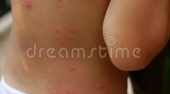 蚊子和其他昆虫的叮咬在孩子的背上
